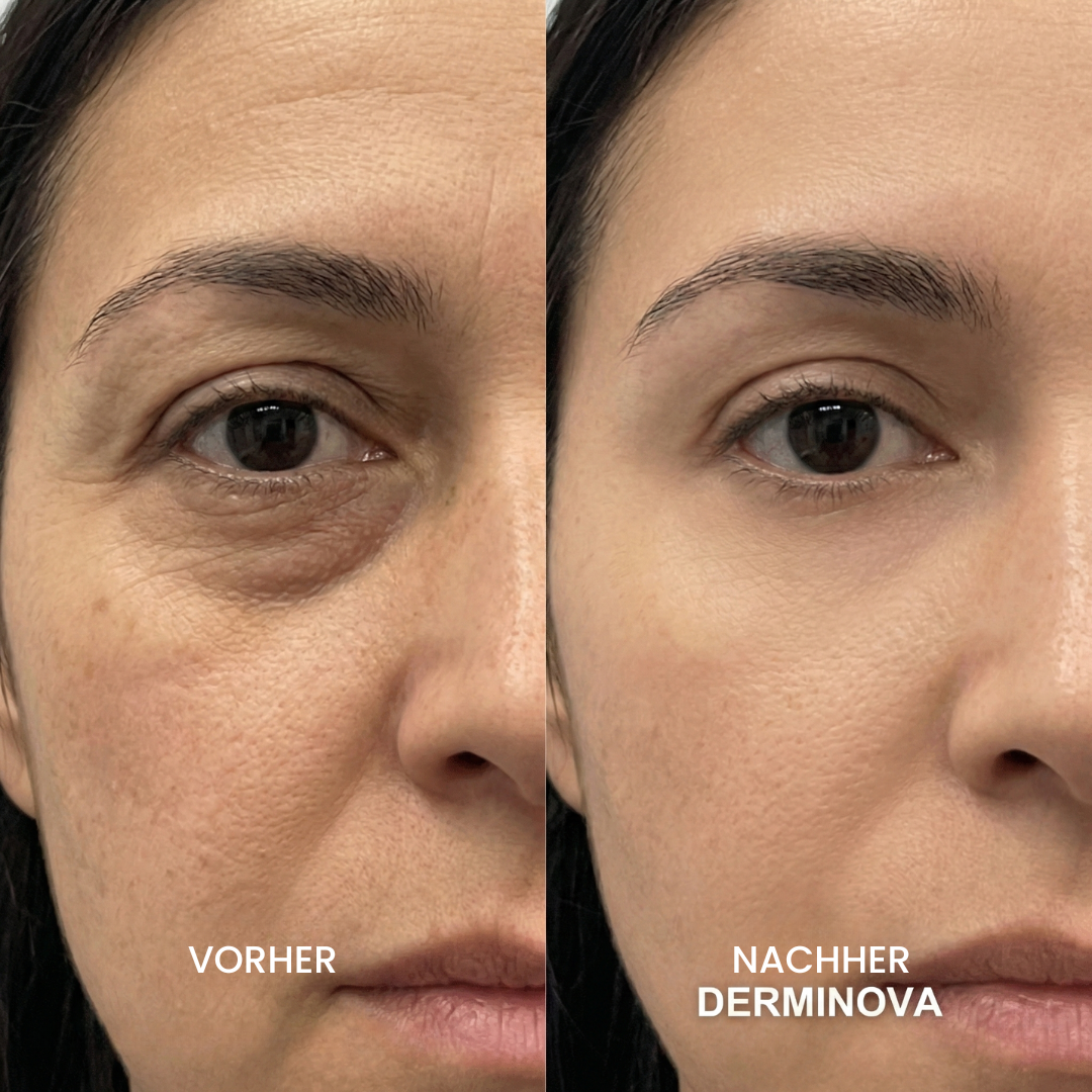 Derminova Micro Infusion System™