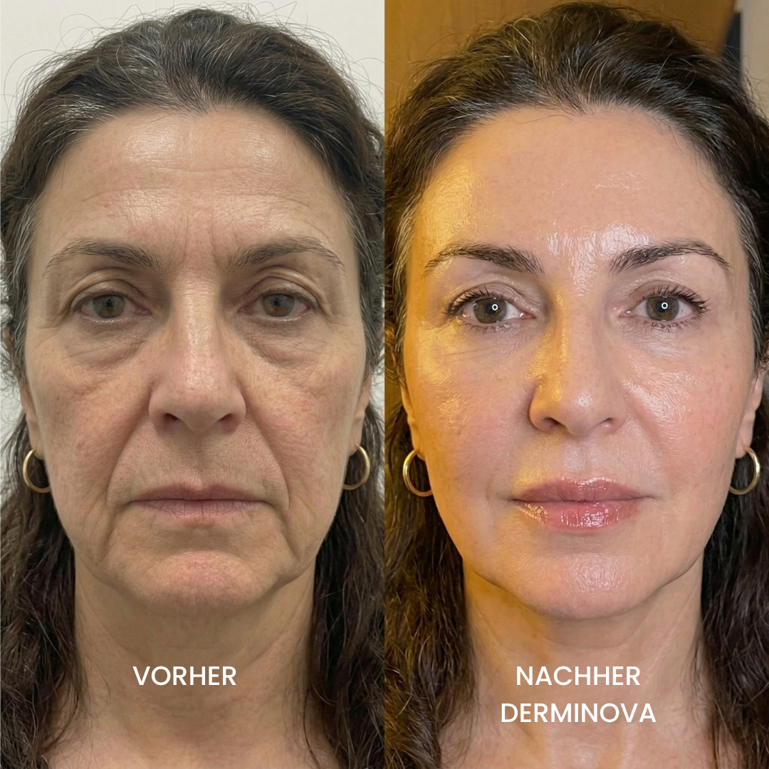 Derminova Micro Infusion System™