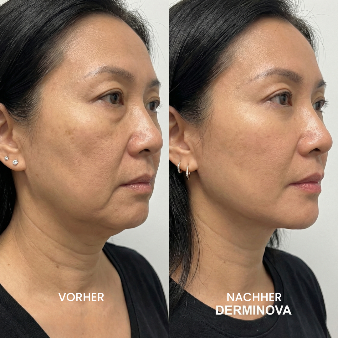 Derminova Micro Infusion System™