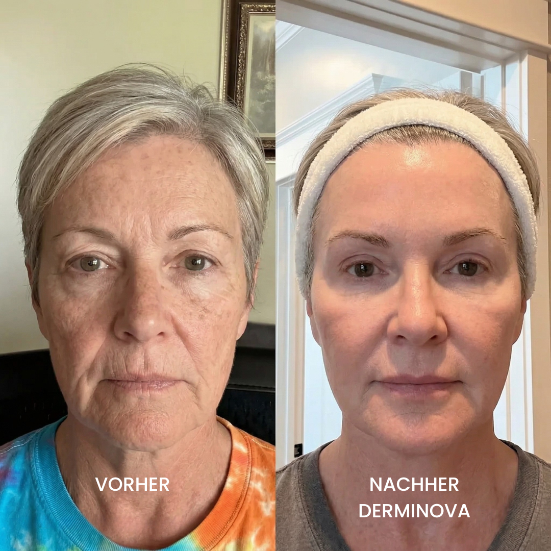Derminova Micro Infusion System™