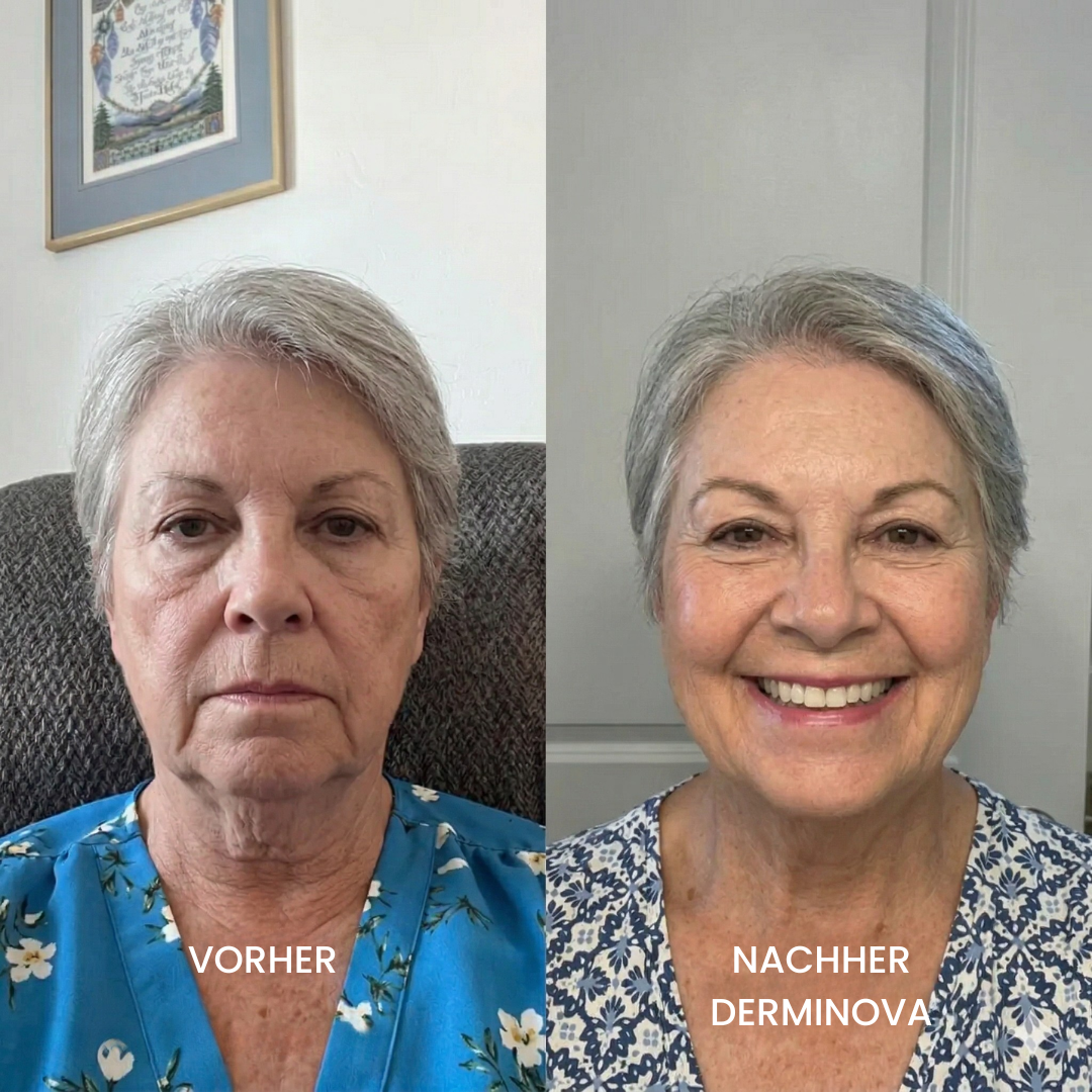 Derminova Micro Infusion System™